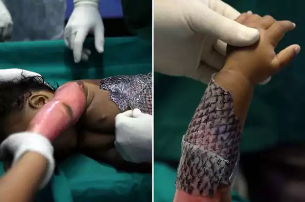 Desperate Doctors Use Fish Skin To Treat Severe Burn Victims See Photos